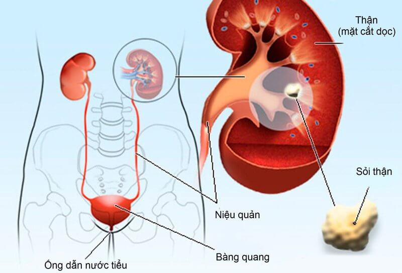 Bị Sỏi Thận có đi XKLD Nhật Bản được không? 2 benh soi than